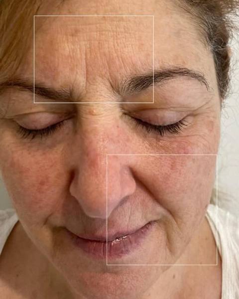 Before: A smoother-looking forehead