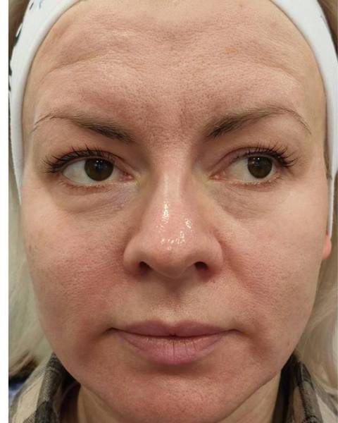 Before: A more defined-looking facial oval