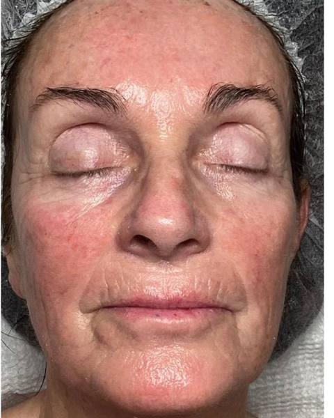 After: A firmer, more toned-looking face