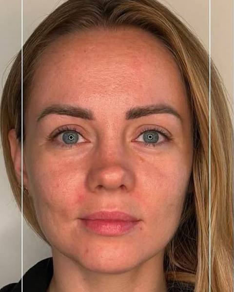 Before: More lifted-looking cheekbones